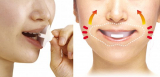 Face Upper anti-aging mouthpiece